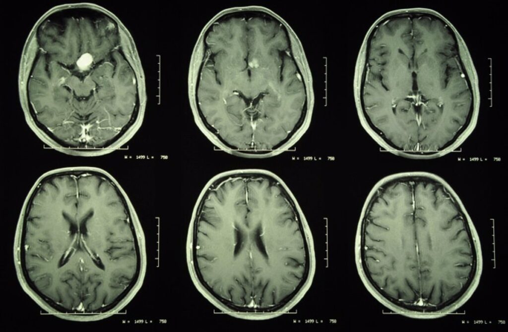 ¿Meningioma difícil de tratar? Radiofármacos podrían ser la solución