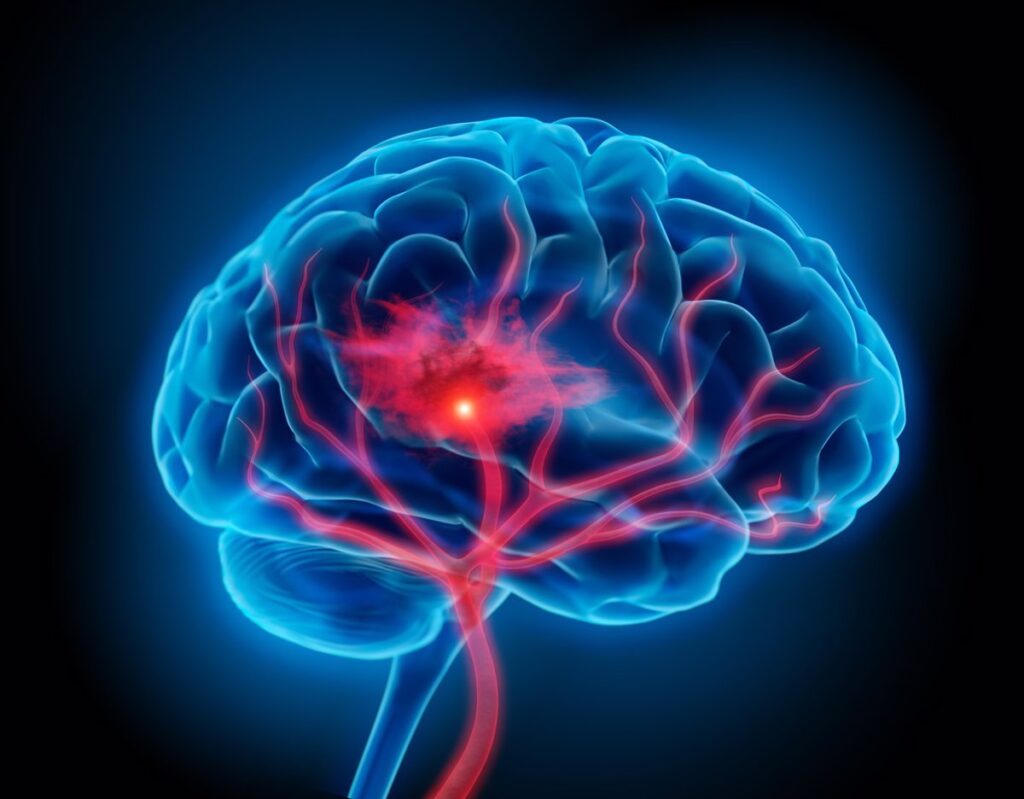 Nueva evaluación visual de 15 minutos mejora el diagnóstico en pacientes con ictus